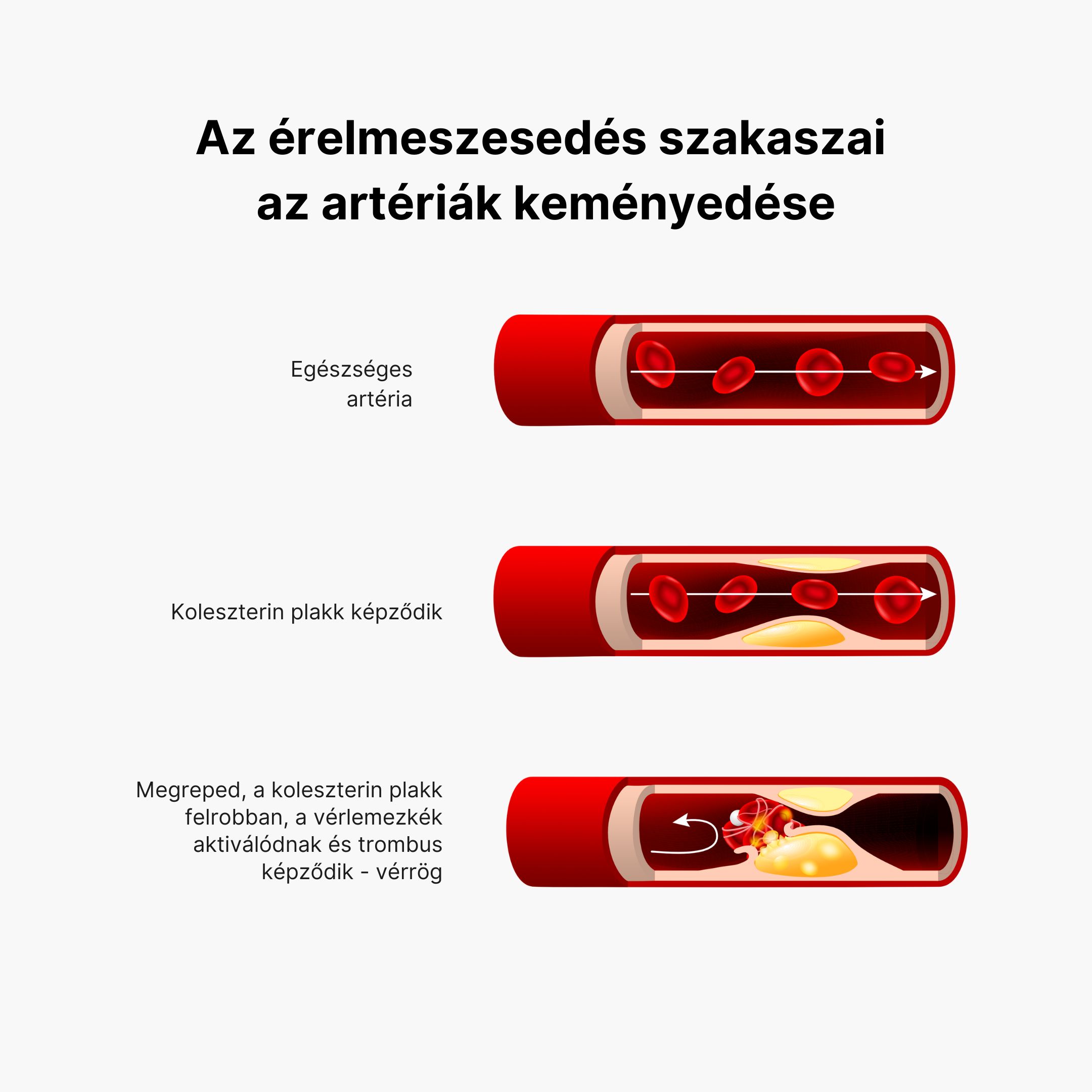 (Maďarština) Arterioskleróza 